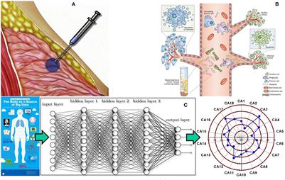 Statistical biopsy: An emerging screening approach for early detection of cancers